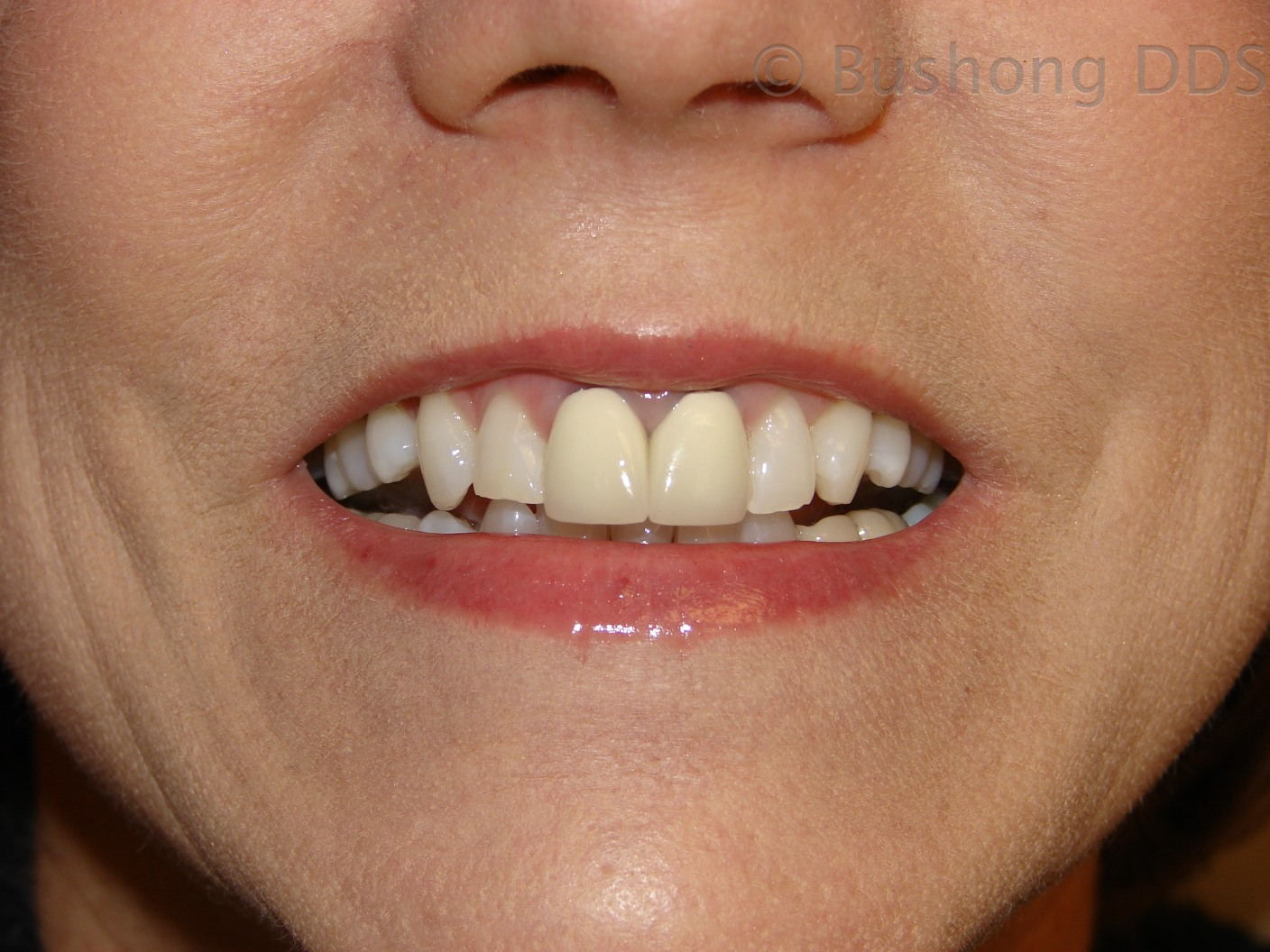 whitened teeth before and after The best guide to teeth whitening